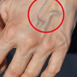 Health If you have visible veins, this means that…
